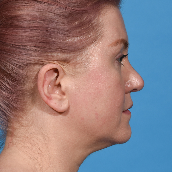 before neck liposuction right