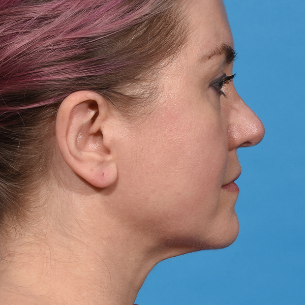 after neck liposuction right