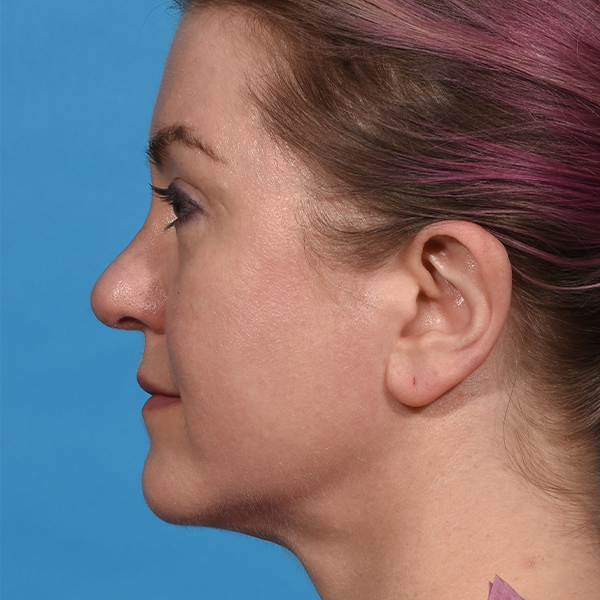 after neck liposuction left