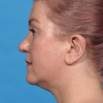 before neck liposuction left
