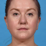 before neck liposuction front