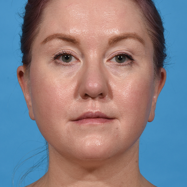 before neck liposuction front