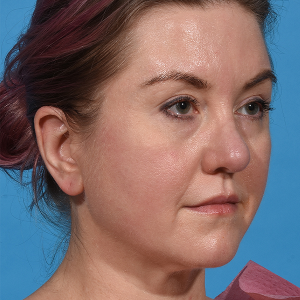after neck liposuction angle right