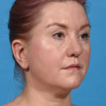 before neck liposuction angle right