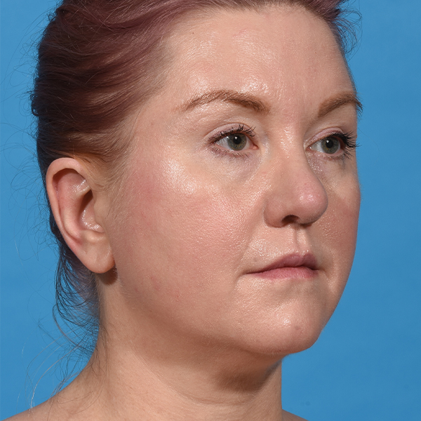 before neck liposuction angle right