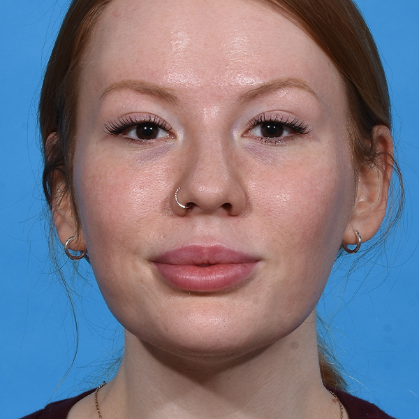 after neck liposuction front