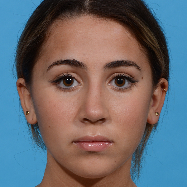 after rhinoplasty front