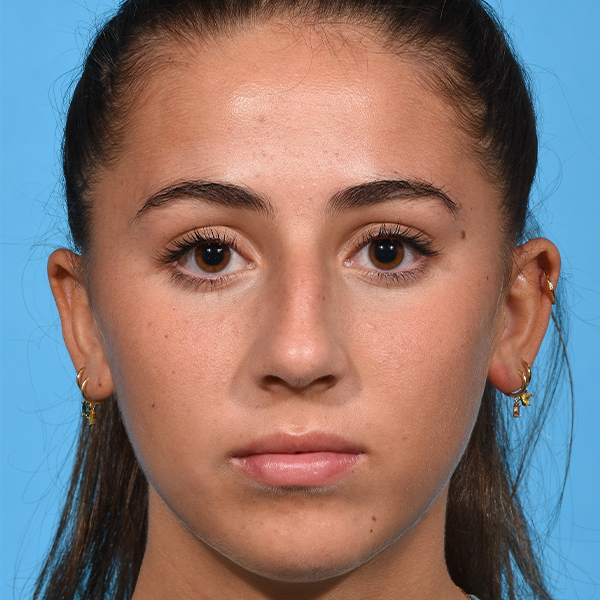 before rhinoplasty front
