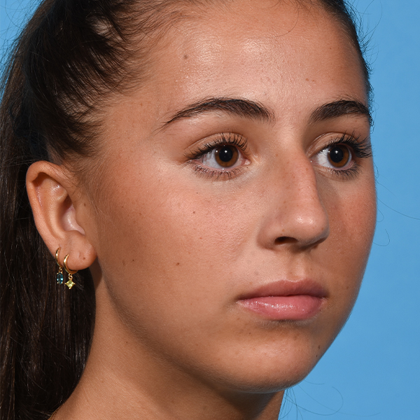 before rhinoplasty angle right