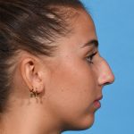 before rhinoplasty right