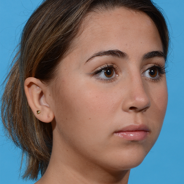 after rhinoplasty angle right