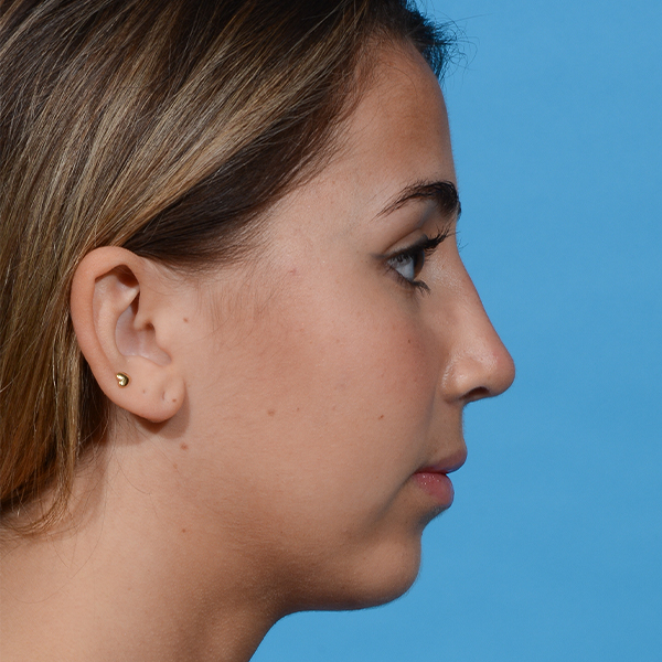 after rhinoplasty right