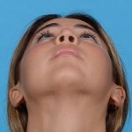 after rhinoplasty up
