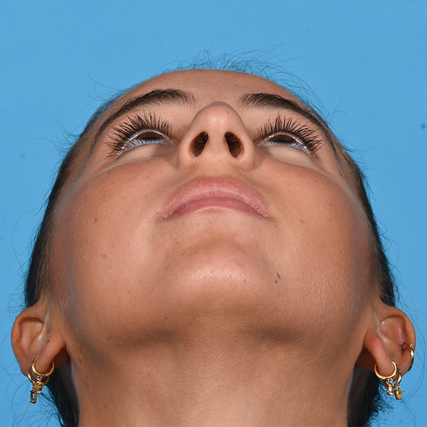 before rhinoplasty up