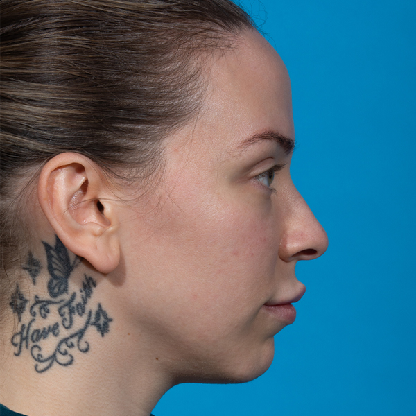 before rhinoplasty right
