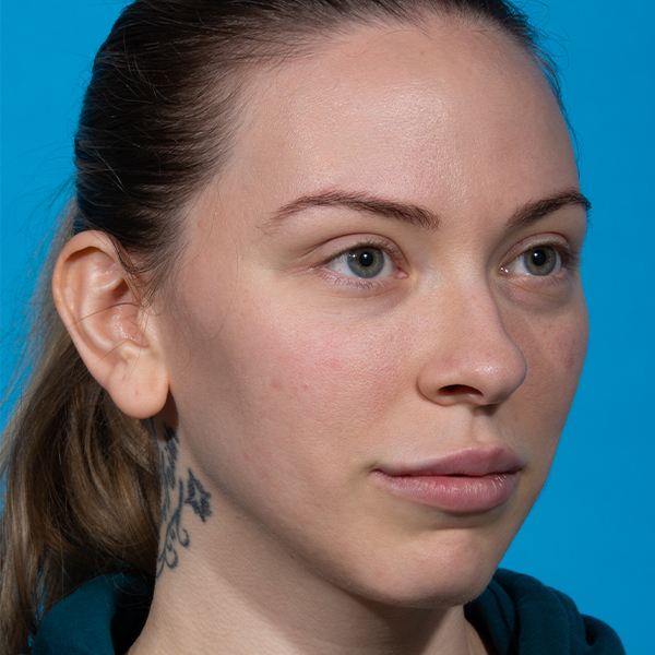before rhinoplasty angle right