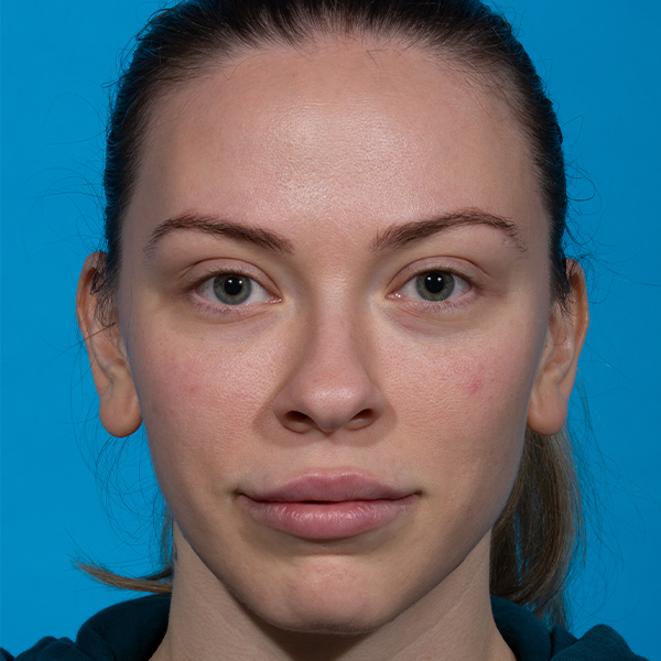 before rhinoplasty front
