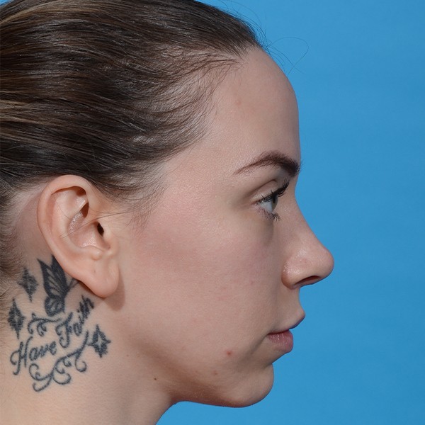 after rhinoplasty right