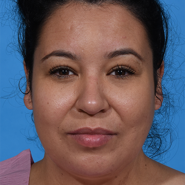 after rhinoplasty front