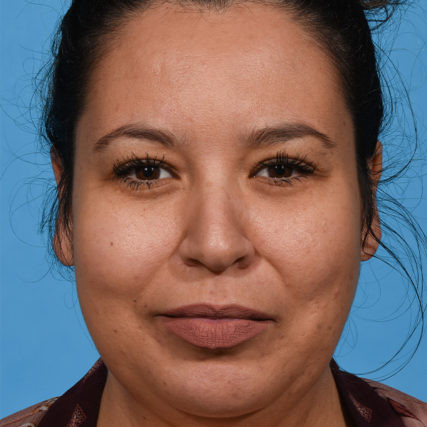 before rhinoplasty front
