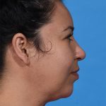after rhinoplasty right