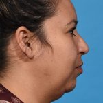 before rhinoplasty right