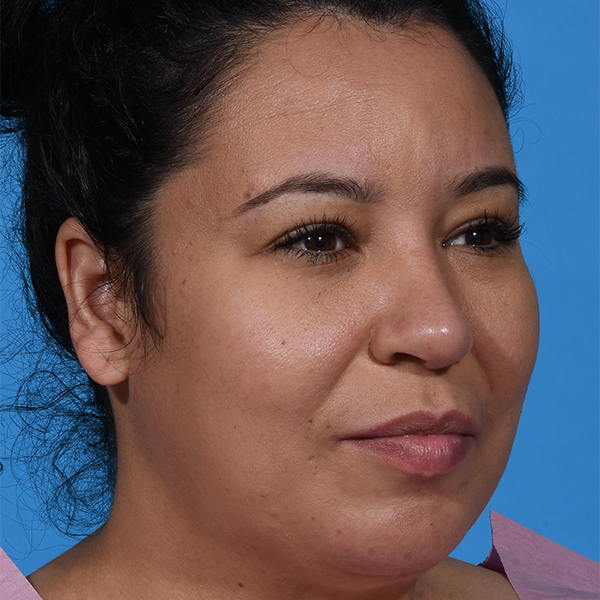 after rhinoplasty angle right