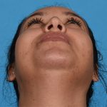 after rhinoplasty up
