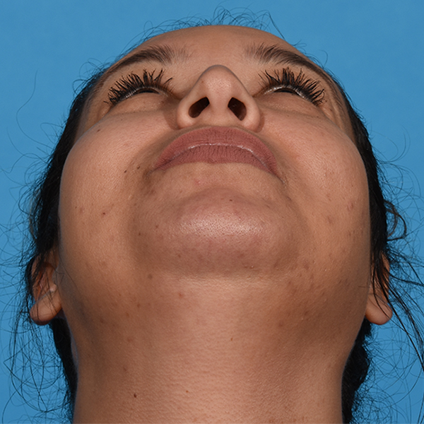 after rhinoplasty up