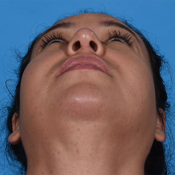 before rhinoplasty up