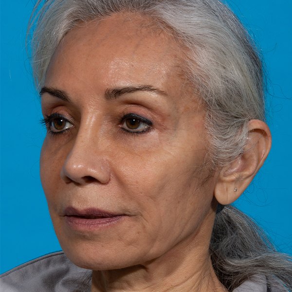 after rhinoplasty angle left patient case 2616