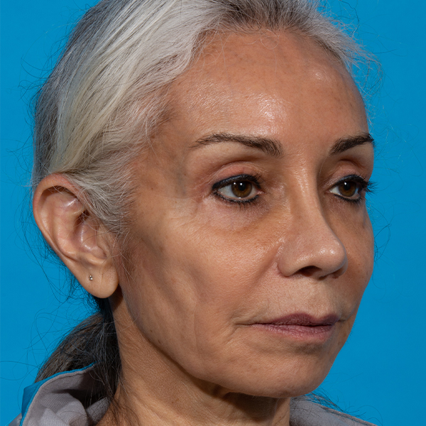 after rhinoplasty angle right patient case 2616