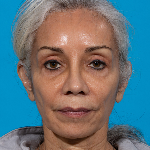 after rhinoplasty front view female patient case 2616