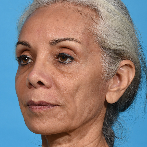 before rhinoplasty angle left patient case 2616