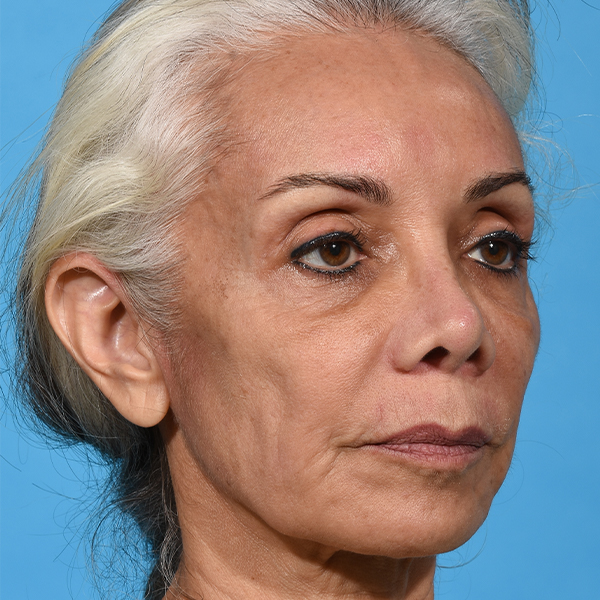 before rhinoplasty angle right patient case 2616