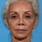 before rhinoplasty front view female patient case 2616