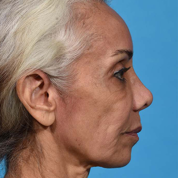 before rhinoplasty side view female patient case 2616
