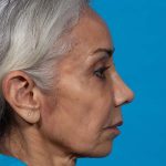 after rhinoplasty side view female patient case 2616