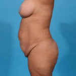 before tummy tuck left