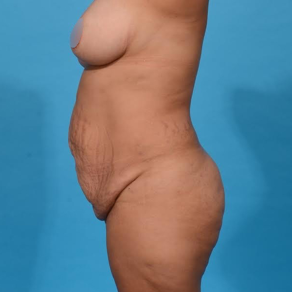before tummy tuck left