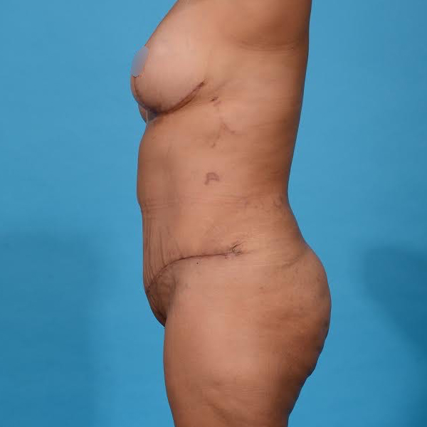 after tummy tuck left