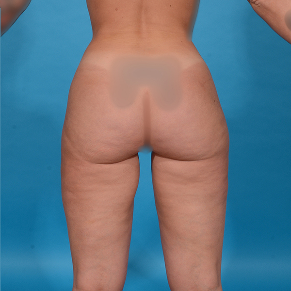 after brazilian butt lift back view case 3516