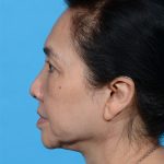 after eyelid lift side view case 3676