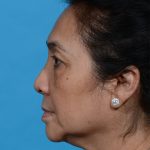 before eyelid lift side view case 3676