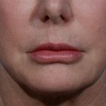 before lip lift front view case 3612