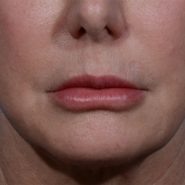 before lip lift front view case 3612