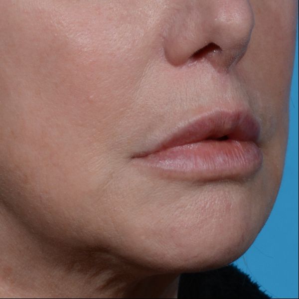 after lip lift angle view case 3612
