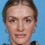 before rhinoplasty female patient front view case 3529