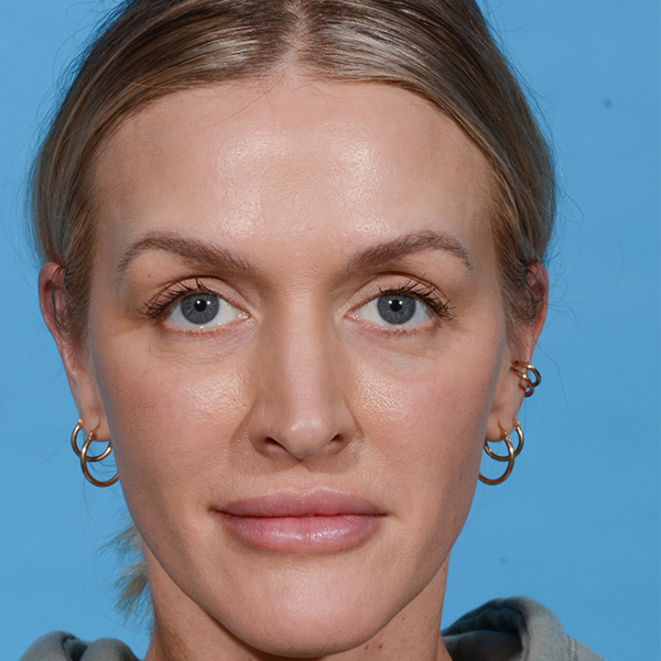 before rhinoplasty female patient front view case 3529
