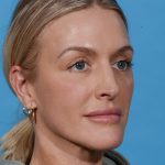 before rhinoplasty female patient angle view case 3529